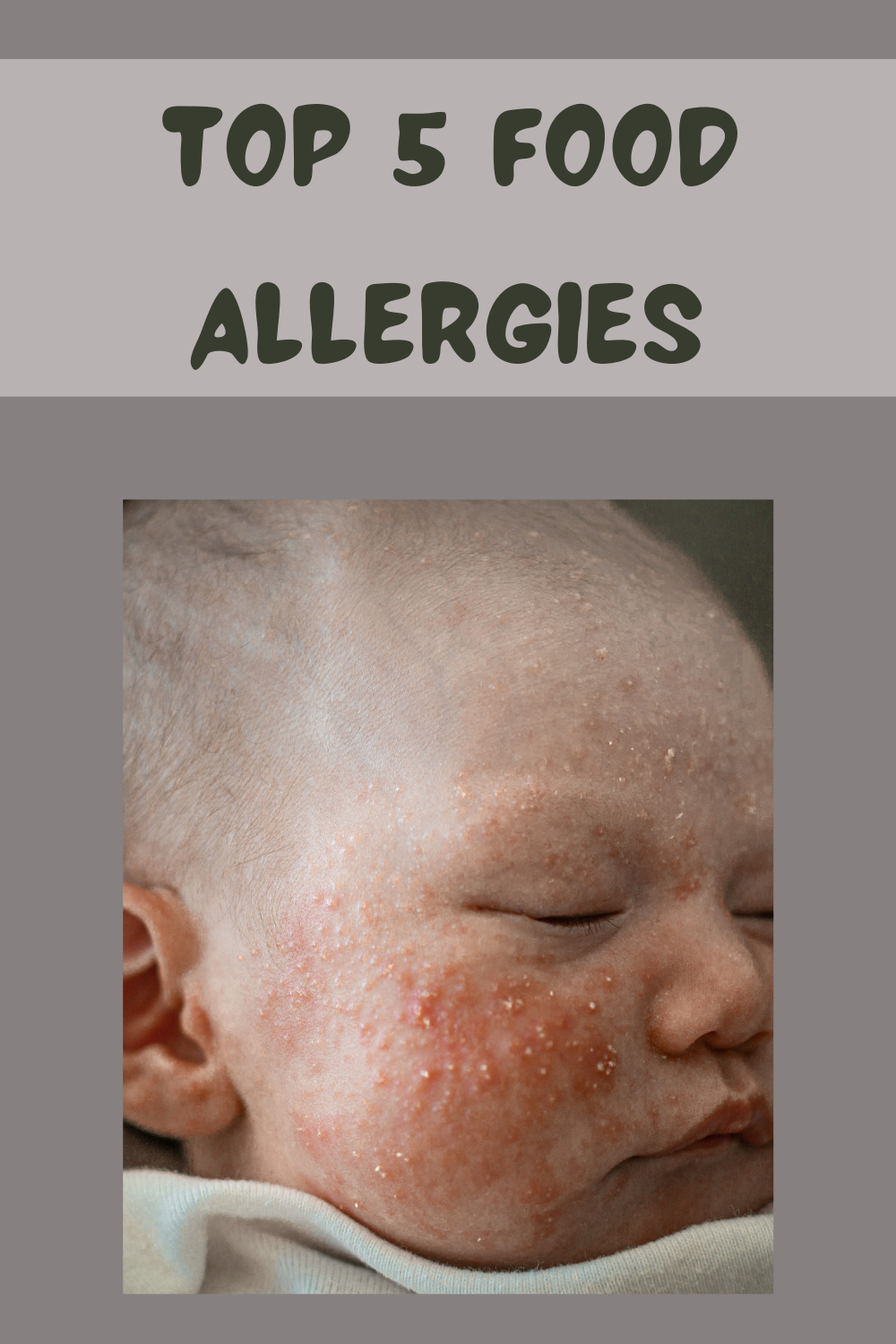 Top 5 Food Allergies