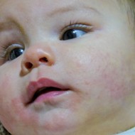 Low Vitamin D in Children Linked to Baby Eczema