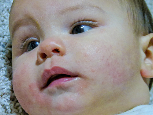 Low Vitamin D in Children Linked to Baby Eczema
