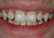Surprising Link between Tooth Damage and Celiac Disease
