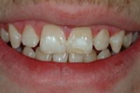 Surprising Link between Tooth Damage and Celiac Disease