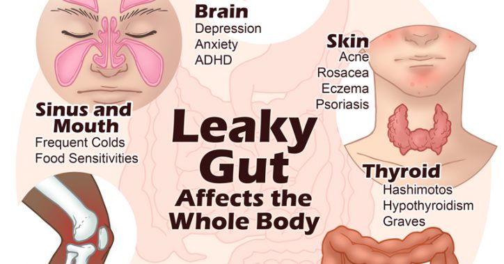 What Does a Leaky Gut Look Like?