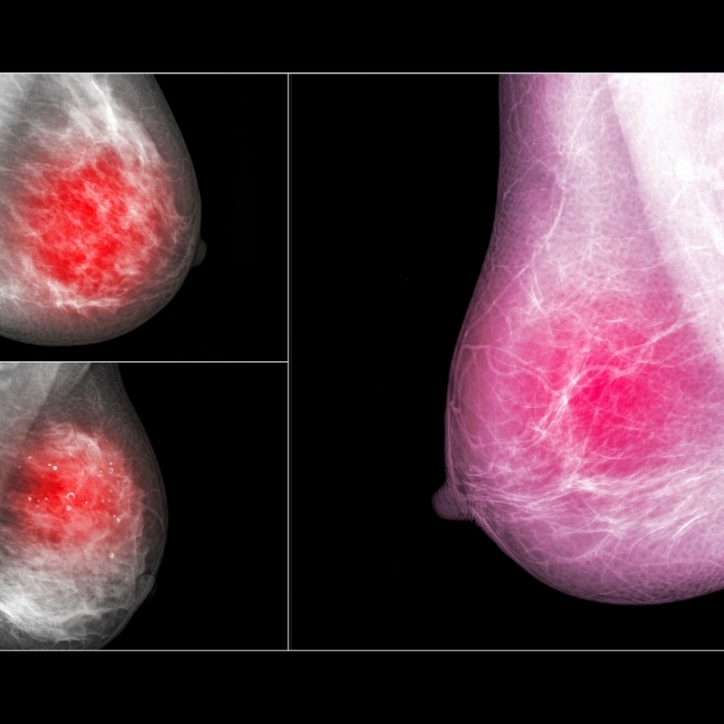 What You Need to Know After Being Diagnosed with Breast Cancer